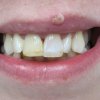 Internal Bleaching After